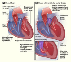 Ventricular Septal Defect - Cardiothoracic Surgery