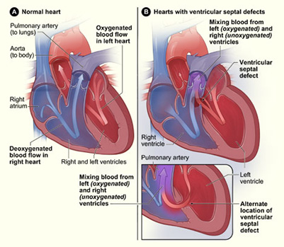 Braz J Cardiovasc Surg - The pulmonary vascular blood supply in the  pulmonary atresia with ventricular septal defect and its implications in  surgical treatment