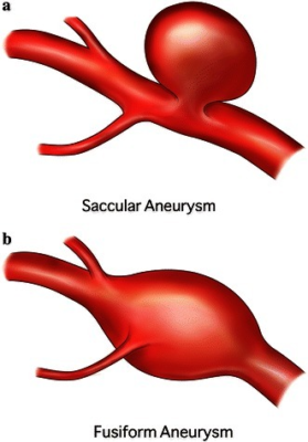 Medical diagram showing two types of aneurysm: saccular, which looks like a tube with a bulbous inflated section branching off a portion of it, and fusiform, which looks like a tube that has bloated up in the middle from some kind of blockage.