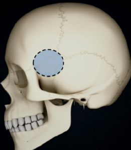 craniotomy - Neurosurgery