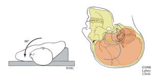 Acoustic Neuromas: What You Should Know - Neurosurgery