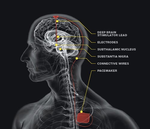 Department of Neurosurgery Parkinson's disease graphic poster